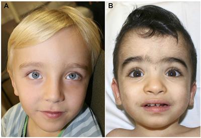 Case report: KPTN gene-related syndrome associated with a spectrum of neurodevelopmental anomalies including severe epilepsy